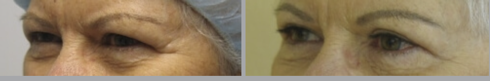 Eyelid Surgery or Blepharoplasty in Ventura, CA